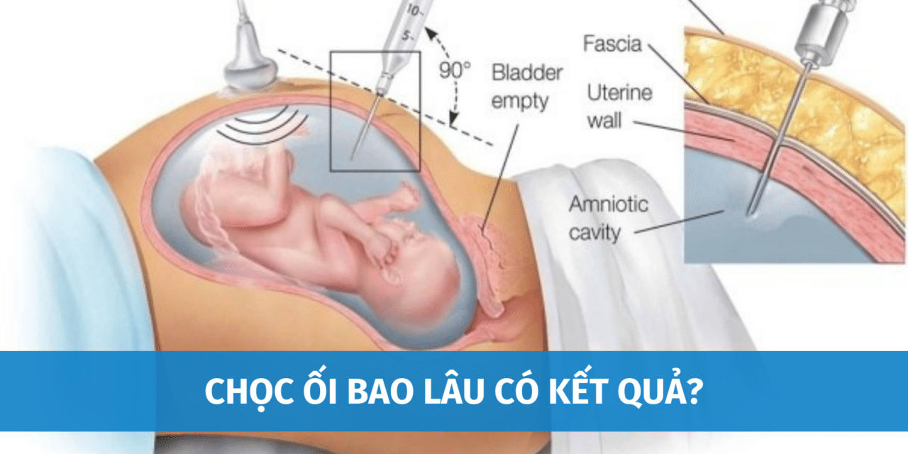Chọc Ối Bao Lâu Có Kết Quả? Nguy Cơ Có Thể Mắc Phải Khi Chọc Ối